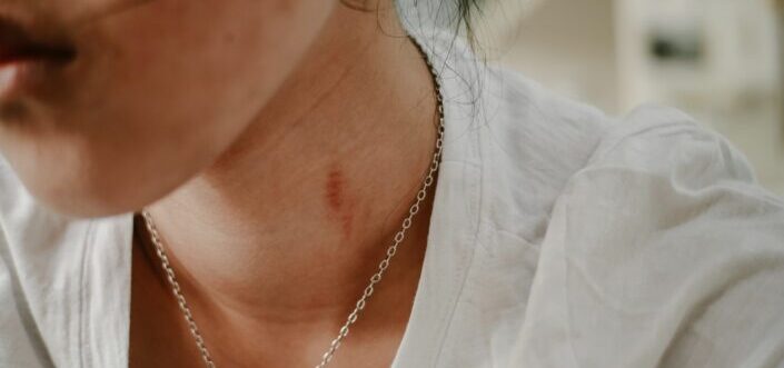 A woman with a hickey mark on her neck.